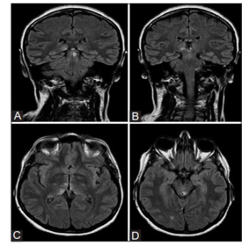 Mild symptomatic Wernicke’s Encephalopathy: a case report