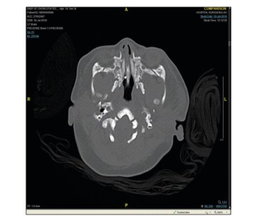 Bilateral inferior conchae and turbinate hypertrophy causing pseudo choanal atresia